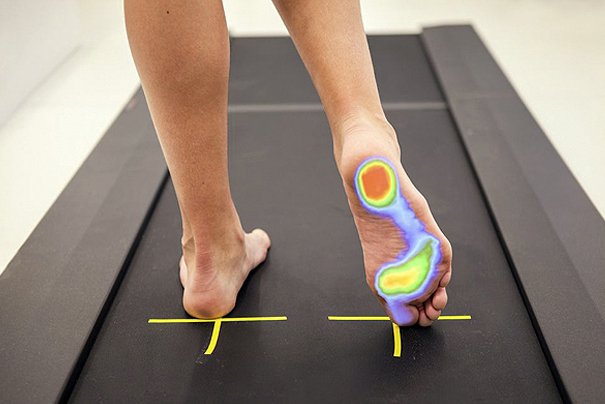 Análisis de la pisada en un estudio biomecánico para evaluar el diagnóstico podológico.