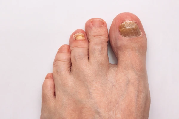 Eficacia del tratamiento láser onicomicosis y sesiones necesarias para hongos en uñas.